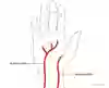 Bild som visar den anatomiska placeringen av handens artärer arteria radialis och arteria ulnaris.