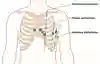 Visar var bröstavledningar ska placeras vid EKG