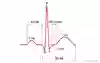 Bild som visar EKG-komplex